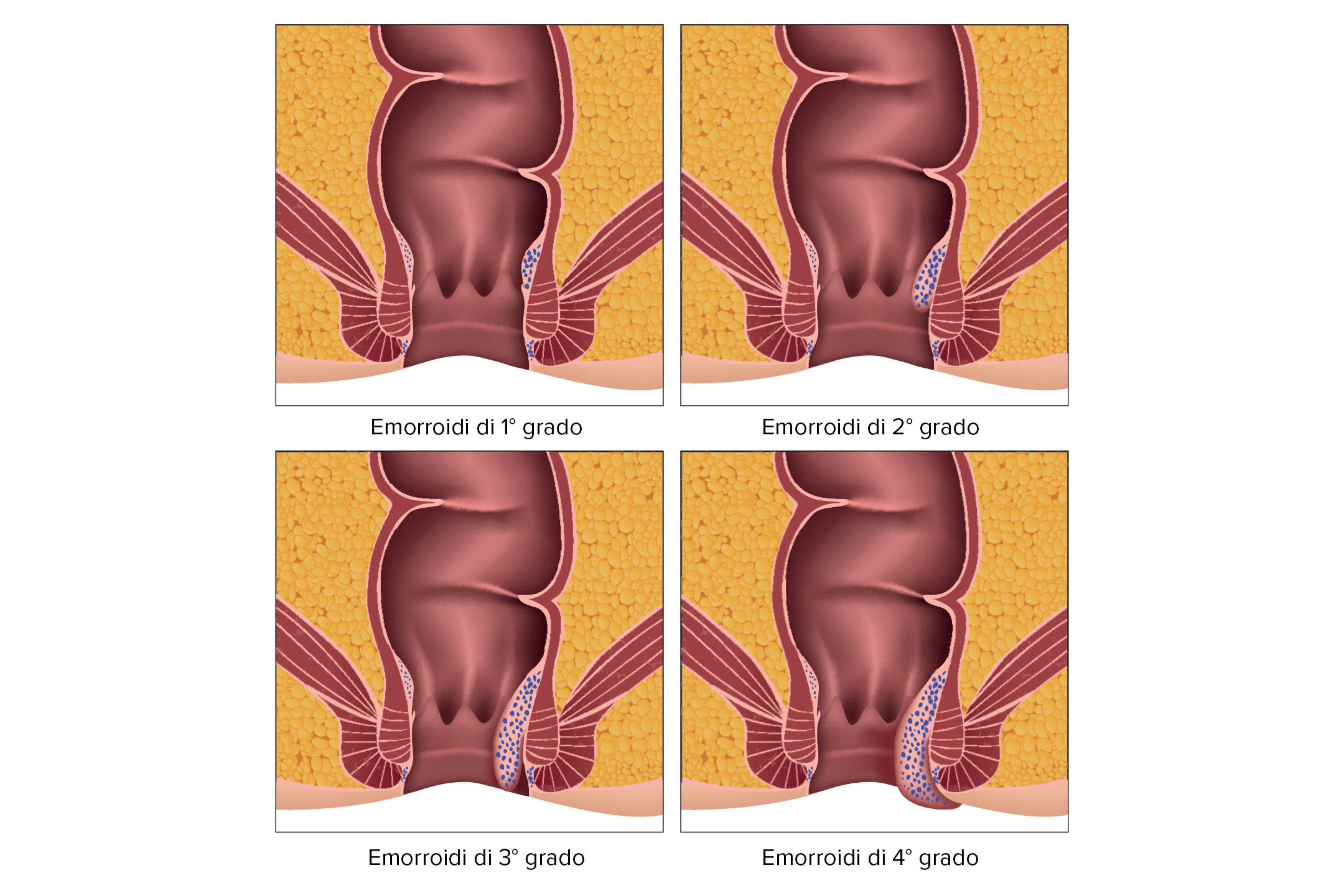 Emorroidi: cause e cosa si può fare?