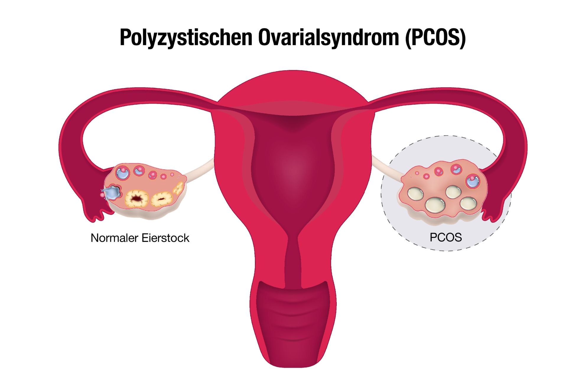 Pco Syndrom Figur