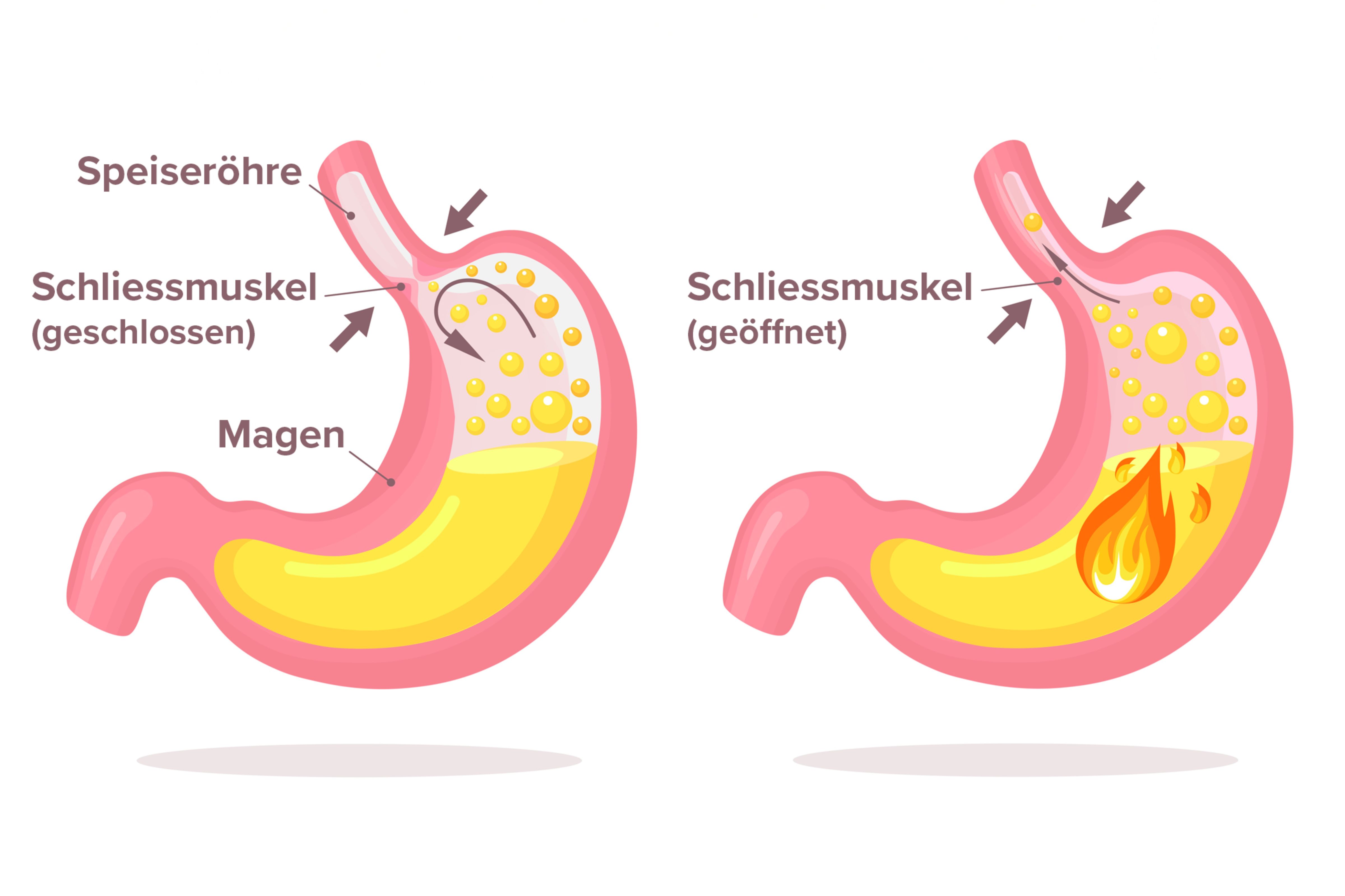 sodbrennen durch e zigarette Sodbrennen: Ursachen, Symptome & Hausmittel